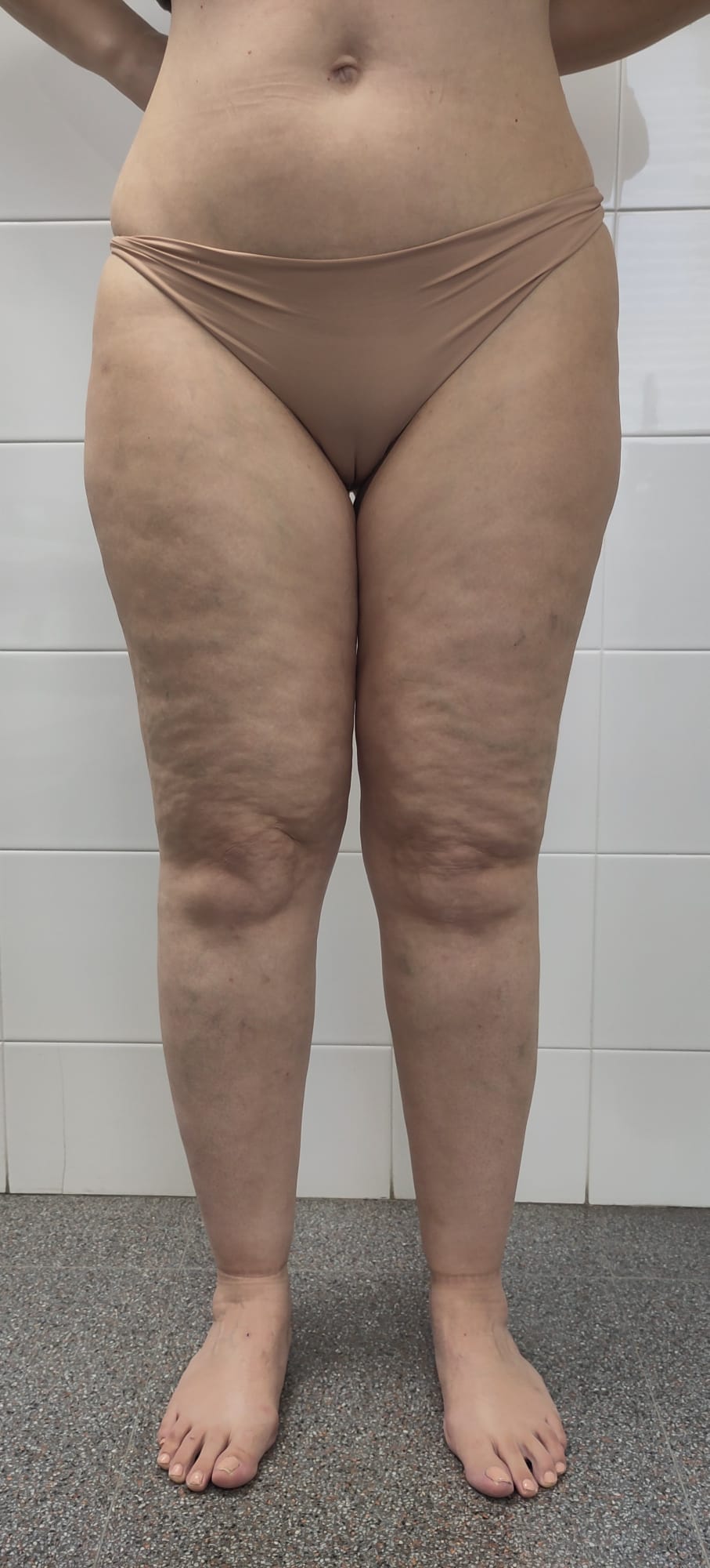 Legs with type III lipedema showing symmetric enlargement from hip to ankle with normally sized feet